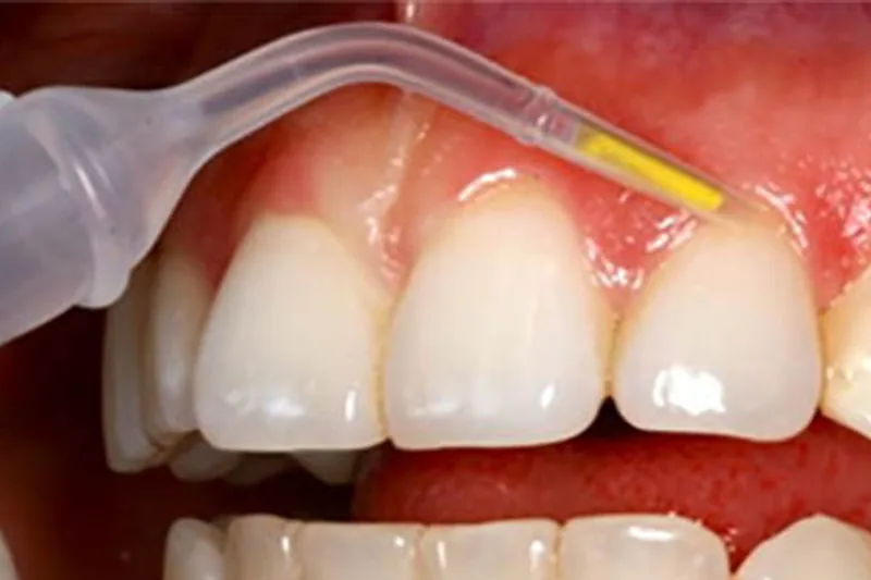 Targeted antibiotic periodontal therapy