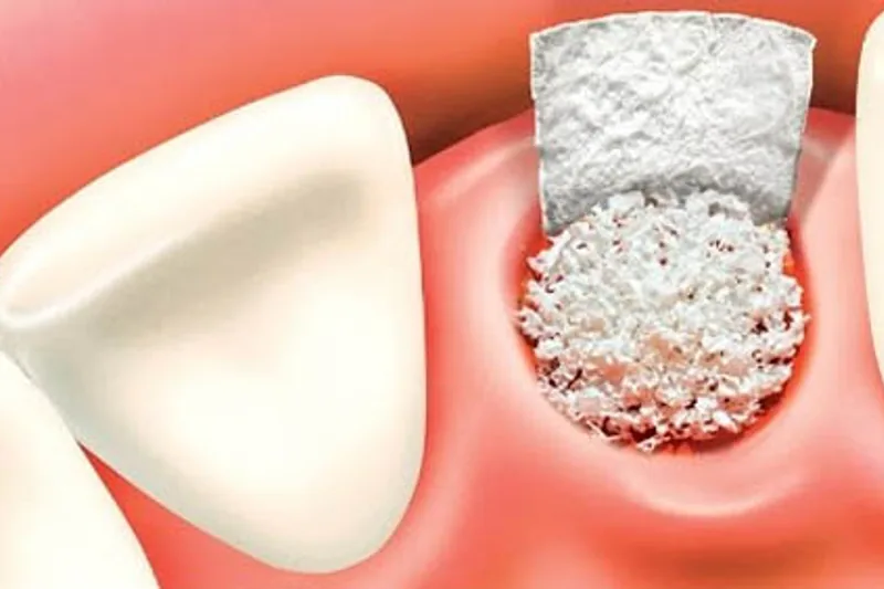 Bone grafting consultation