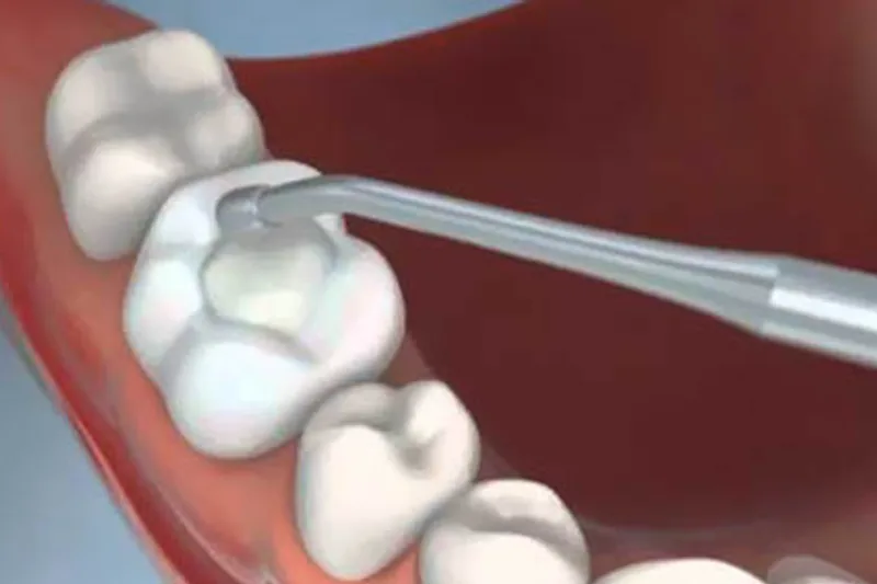Tooth-colored composite filling placement