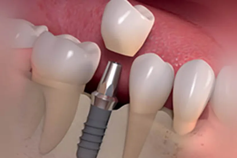 Dental implant restoration model