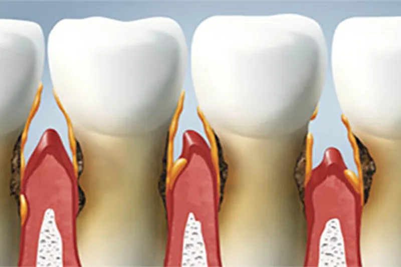 Periodontal screening measurements