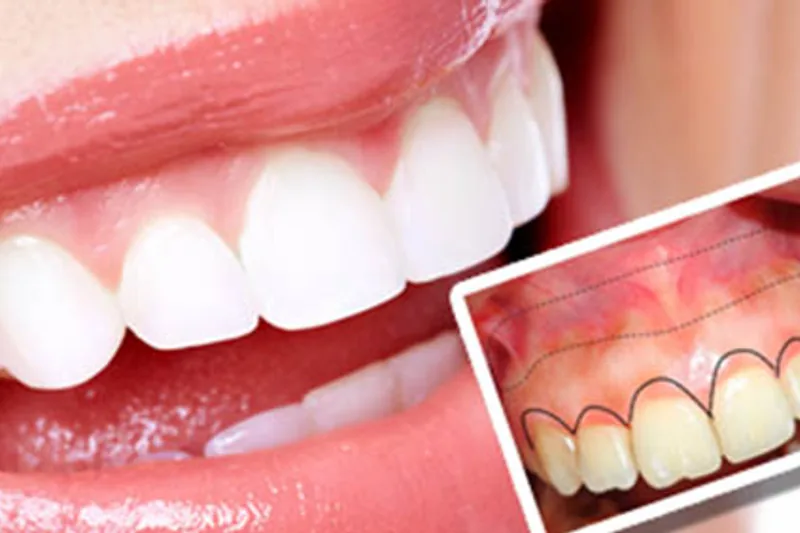 Gum recession evaluation