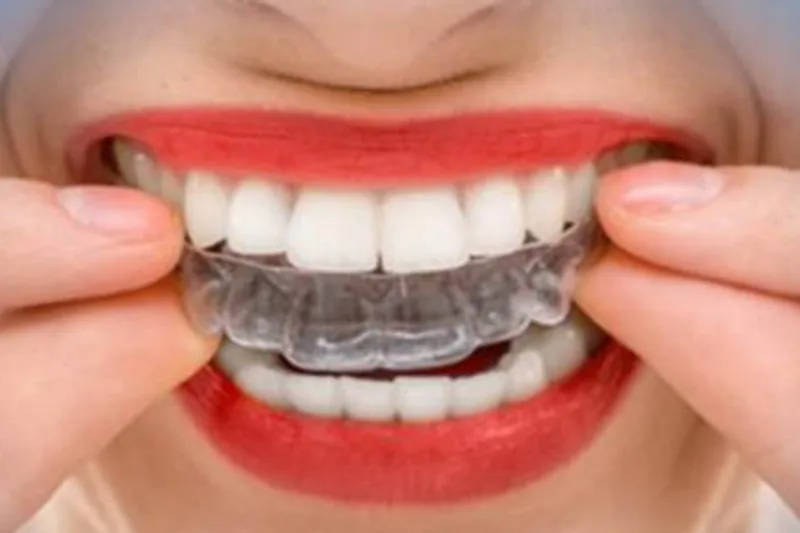 Patient with a clear Invisalign aligner
