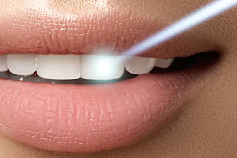 Dental laser handpiece treating a smile