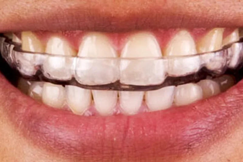 Custom-fit dental night guard