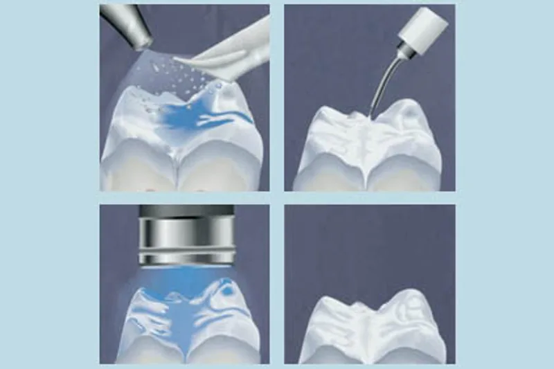 Applying a protective sealant to a child's molar
