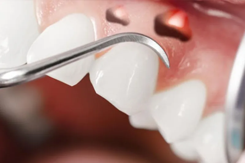 Periodontal abscess care