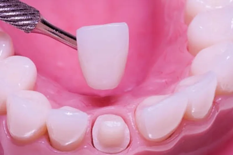 Porcelain crown restoration