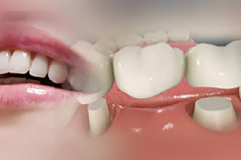 Fixed dental bridge model