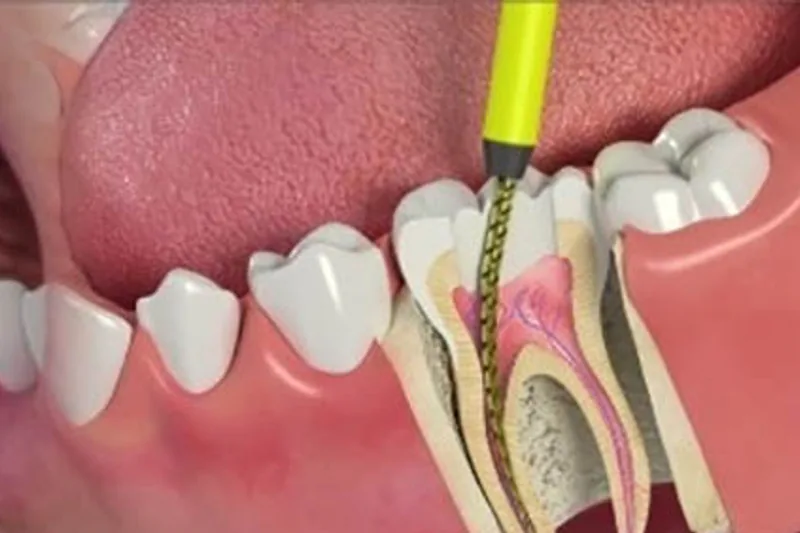 Conservative endodontic treatment