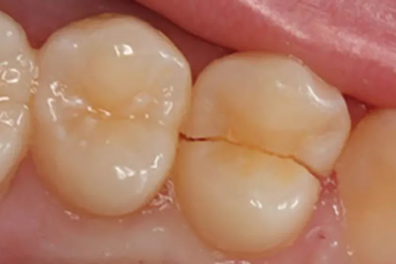 Follow-up endodontic care