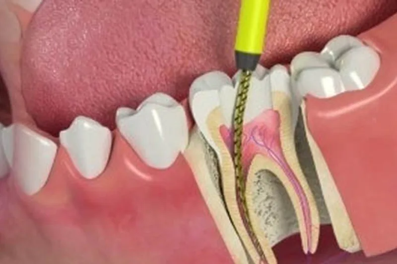 Comfortable root canal treatment